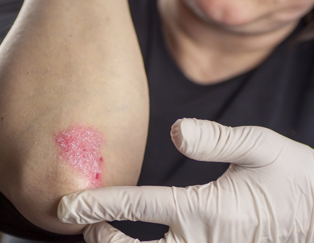Combining Massive Genomic Cohorts With Single-Cell Analysis to Track Autoimmune Diseases