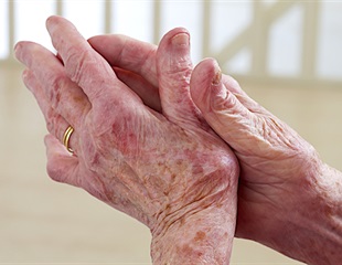 uEXPLORER TB-PET/CT scanner captures complete picture of systemic inflammatory arthritis
