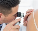 Oral difelikefalin could reduce the intensity of itch in patients with notalgia paresthetica
