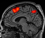 Discovery of Shanghai APP Mutation Offers New Avenues for Treatment of Alzheimer's Disease