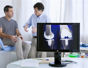 Measurement of plasma D-dimer levels can be useful when diagnosing periprosthetic joint infection