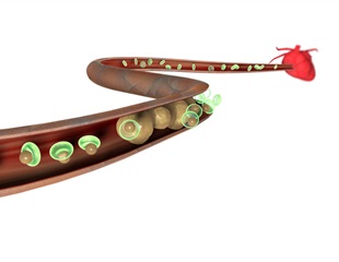Experimental "gene silencing" therapy reduces a important driver of heart disease risk by up to 98%