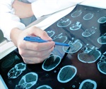 Disrupted circadian rhythms in older adults linked to increased risk of Parkinson's disease
