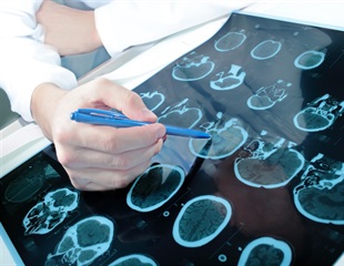 The Molecular Process That Causes MS and Autoimmune Diseases