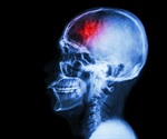 Study Uncovers Somatic Mutations That Play a Role in Common Form of Adult Epilepsy