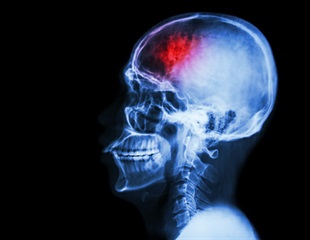 Study Confirms Comparable Efficacy of Lamotrigine and Mexiletine in Muscle Channelopathy