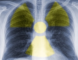 Pre-Targeted Radioimmunotherapy System Cures Fatal Ovarian Cancer in Preclinical Study