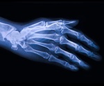 Functional bone imaging technique reveals the progression of knee osteoarthritis
