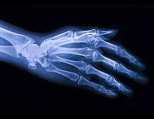 New Genetic Discoveries Offer Hope for Osteoarthritis Treatments