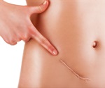 Researchers Identify Mechanism of Immune Suppression in Ovarian Cancer