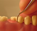 Double-stranded RNA provoke bone loss during periodontitis