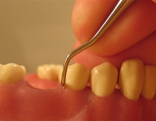 Study reveals bacterial signature that marks the shift from healthy teeth, gums to periodontitis