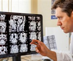 Study shows two phases of wall restructuring after an aneurysm forms