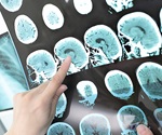 Specific Genes May Determine Stroke Recovery Path