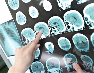 Active immune cells provide great protection against ischemic stroke