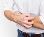 Gene biomarker can distinguish between atopic dermatitis and psoriasis with 100% accuracy