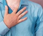 Engineered Mice Carrying the Genetic Variant Develop Excessive Sweating