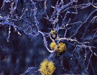 Breakthrough Method Captures Aging Impact on Alzheimer’s Disease in Lab-Grown Neurons