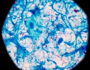 Study Reveals How Tuberculosis Bacteria Survive Airborne Journey