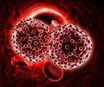 New Genomic Score Predicts Risk of Progression in Multiple Myeloma