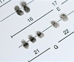 Researchers Identify Genes Responsible for Craniofacial Dysmorphology in Down Syndrome