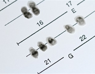 Researchers Identify Genes Responsible for Craniofacial Dysmorphology in Down Syndrome