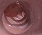 Loss of SOX9 Gene Linked to Aggressive Colorectal Cancer