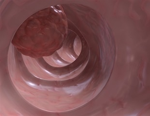 Scientists discover link between two signaling pathways crucial to growth of colon cancer