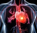 Recent cannabis use associated with myocardial infarction in young adults