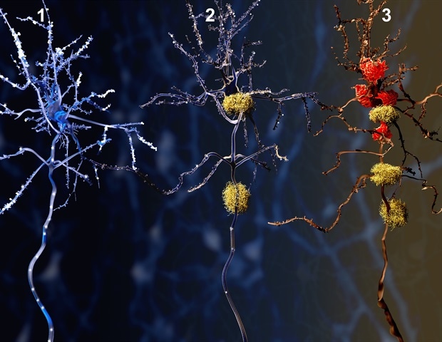 Researchers Identify Peptide That Counters Key Processes of Neurodegenerative Disorders