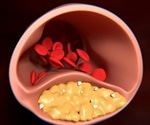 Risk linked to coronary arteriosclerosis may be explained by changes in gene networks