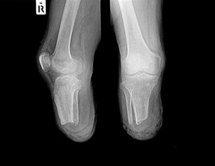 LSTM Scientists Discover Treatment for Tissue Damage by African Spitting Cobra Venom