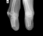 Small, flexible implant relieves pain on demand and without the use of drugs