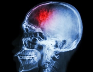 Study Uncovers Connection Between Neuronal Overactivation and Parkinson’s Disease