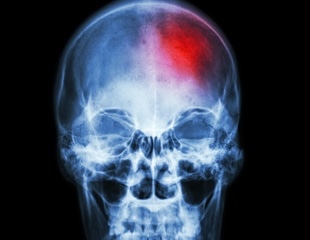 Study Uncovers Connection Between Neuronal Overactivation and Parkinson’s Disease