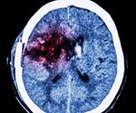 Common Genetic Variation Doubles Dementia Risk in Men, Study Finds