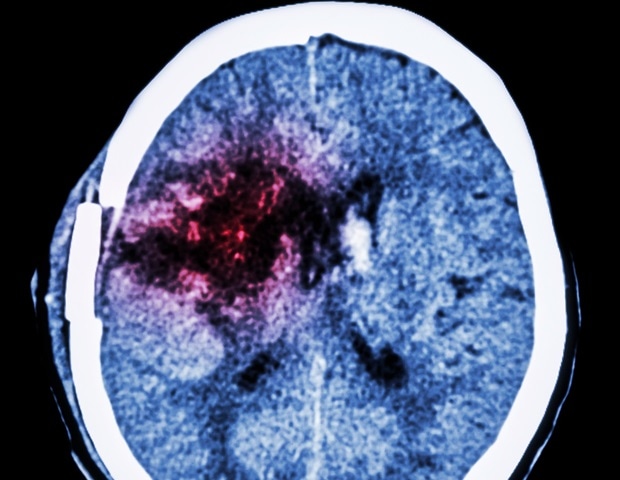 New Karyoptosis Mechanism Linked to Alzheimer's and Frontotemporal Dementia