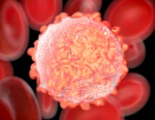 New Genomic Score Predicts Risk of Progression in Multiple Myeloma