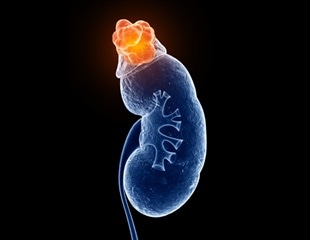 Cleveland Clinic Study Reveals Link Between Kidney Microbiome and Kidney Stones