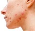Mediterranean Diet Linked to Lower Likelihood of Acne in Adults