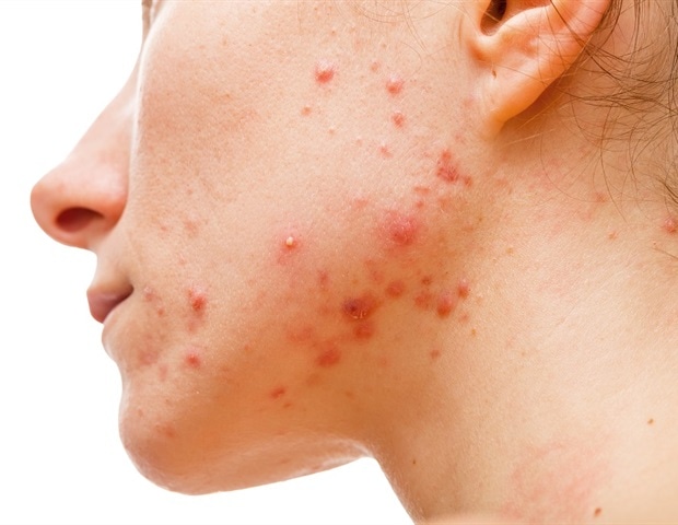 Mediterranean Diet Linked to Lower Likelihood of Acne in Adults