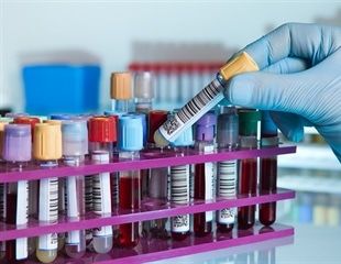 Columbia researchers develop new blood test to measure the pace of biological aging
