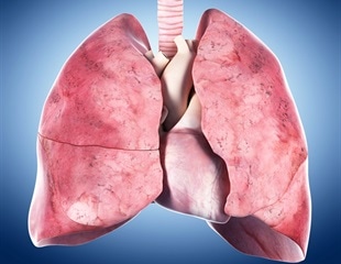 Study Reveals Immune Cells' Role in Lung Scarring After Viral Infections