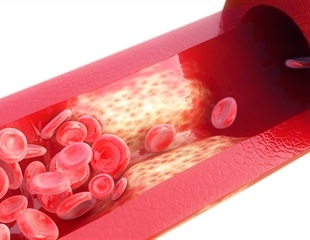Breakthrough 3D Vascular Sheet Mimics Atherosclerosis for High-Throughput Drug Screening