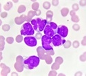 Dual Genetic Mutations Drive RNA Mis-Splicing and Leukemia Progression