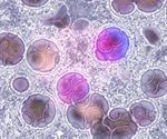 RNA-Seq Unveils Molecular Subtypes for Tailored Pediatric B-ALL Treatment