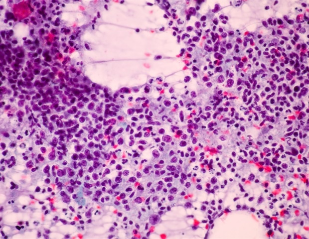Study Explores How Highly Infectious TB Cases Drive Transmission