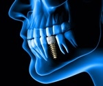 Rethinking Antibiotics: Dental Professionals Embrace New Alternatives For Standard Dental Procedures