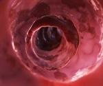 Machine learning algorithm helps differentiate benign and premalignant colorectal polyps