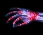 AI Identifies COVID-19 Molecular Mimics Linked to Autoimmune Disease Risk